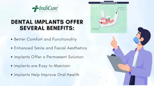 Benefits of dental implants